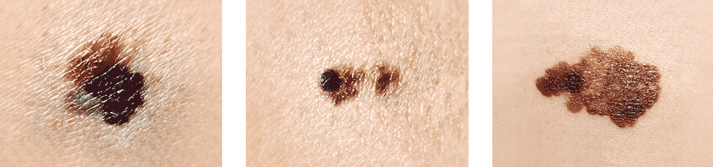 Signs of melanoma pictures